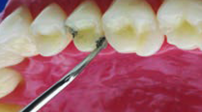 Acteon насадка EXL – Насадка для скайлера, внутренняя половинка шарика, повёрнутая налево под 45, для удобного доступа к жевательным зубам, с алмазным покрытием