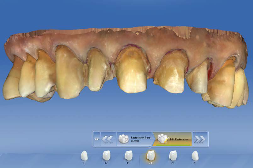 CEREC AC OMNICAM ПРОСТОЕ СКАНИРОВАНИЕ БЕЗ АНТИБЛИКОВОГО СПРЕЯ 8.jpg