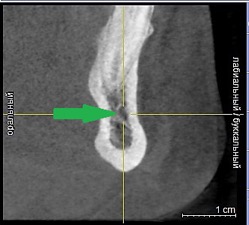 Рисунок 1b- КЛКТ. Коронарныи реформат нижнеи челюсти в переднем отделе. (Зеленая стрелка резцовая петля).jpg