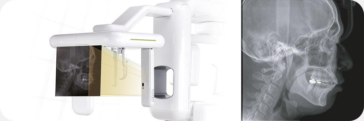 Латеральная проекция дентального компьютерного 3D томографа Genoray Volux 55 с цефалостатом.jpg