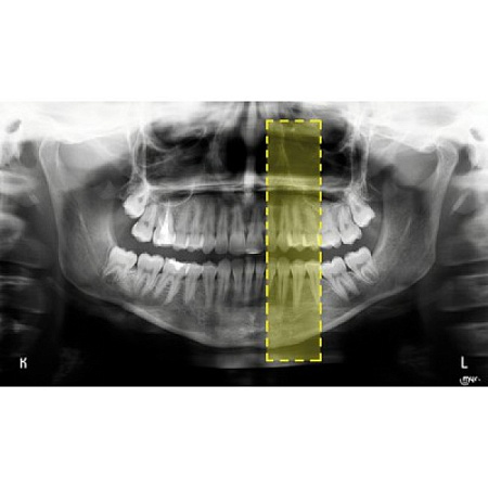 MyRay Hyperion X9 3D-READY Ceph Titanium - дентальный цифровой аппарат с цефалостатом, с возможностью модернизации до 3D томографа