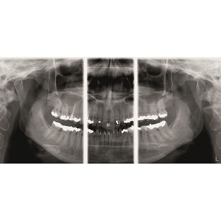 KaVo Pan eXam Plus 3D - цифровая панорамная рентгенодиагностическая система с функцией 3D-томографии 6x8 см и возможностью дооснащения модулем цефалостата