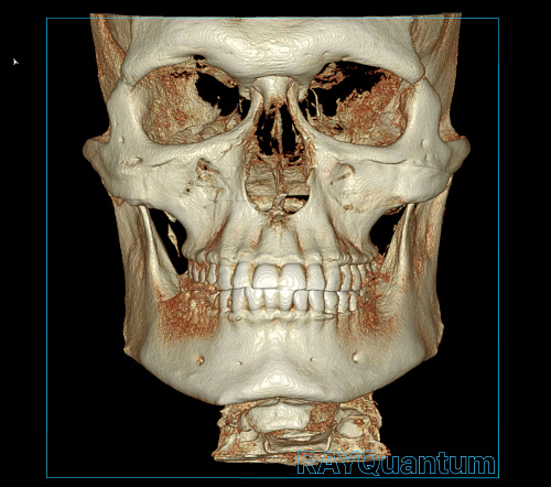 Ray α-SM3D Quantum – Дентальный томограф