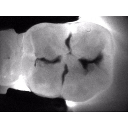 KaVo DIAGNOcam - прибор для диагностики кариозных поражений