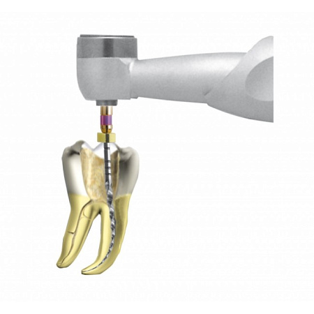 Anthogyr NiTi-Control - наконечник эндодонтический (64:1-понижающий) для любых типов NiTi инструмента