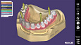 Exocad Implant module - имплант модуль