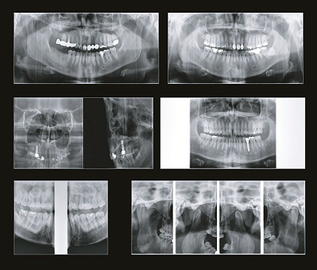 GENORAY Papaya 3D 23x24 - компьютерный томограф с цефалостатом