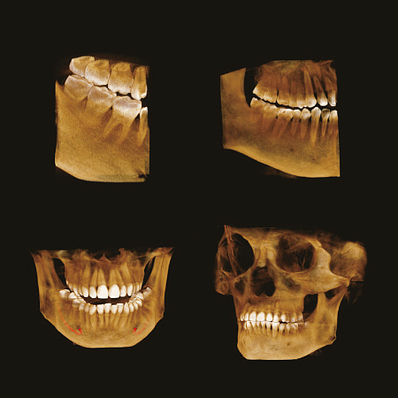 GENORAY Papaya 3D 23x24 - компьютерный томограф с цефалостатом One Shot
