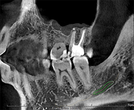 GENORAY Papaya 3D 23x24 - компьютерный томограф с цефалостатом One Shot