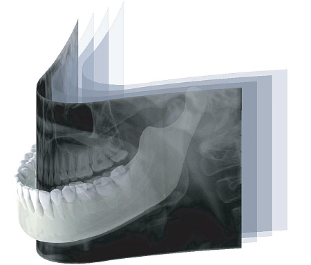 GENORAY Papaya - ортопантомограф с функцией CUST