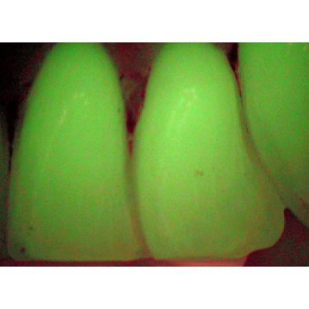 Durr Dental VistaCam IX – интраоральная видеокамера с системой сменных насадок CAM, Proof, Proxi