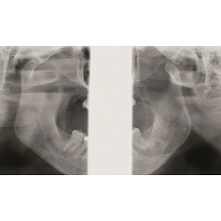 KaVo Pan eXam Plus 3D - цифровая панорамная рентгенодиагностическая система с функцией 3D-томографии 6x8 см и возможностью дооснащения модулем цефалостата