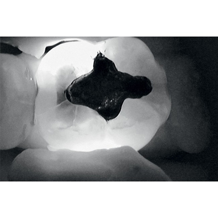 KaVo DIAGNOcam - прибор для диагностики кариозных поражений