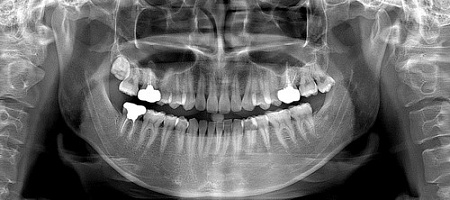 Ray RAYSCAN Alpha P – ортопантомограф