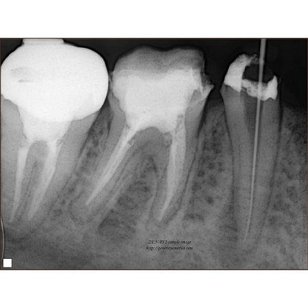 Genoray PORT-X II - портативный высокочастотный интраоральный рентгеновский аппарат