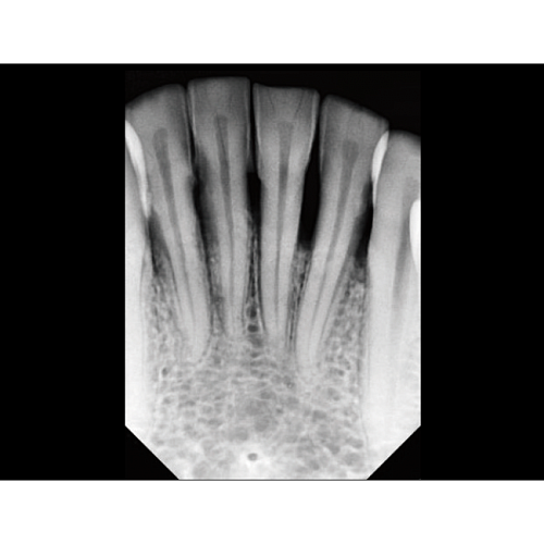 Vatech EzRay Air Wall - высокочастотный настенный дентальный рентген