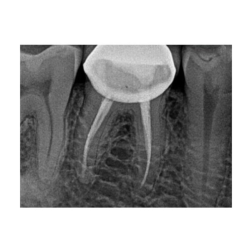 Carestream Kodak RVG 5200 - радиовизиограф